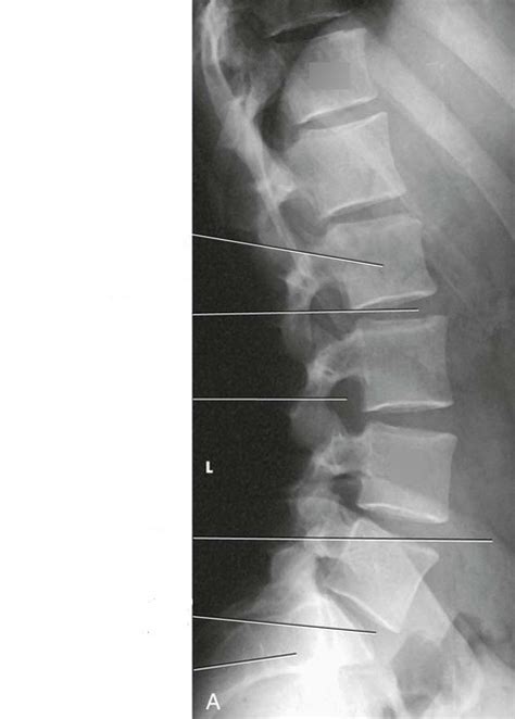 X-ray Anatomy - Lateral Lumbar Spine Diagram | Quizlet