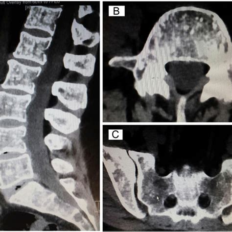 A C Ct Lumbar Spine And Sacrum With Multiple Sclerotic Foci Within