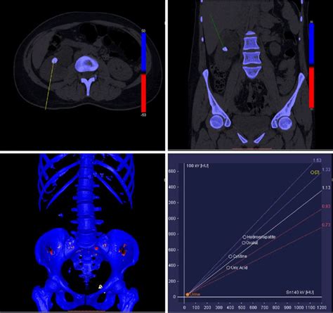 In The Right Collecting System The Stone Encoded As Blue In Axial And