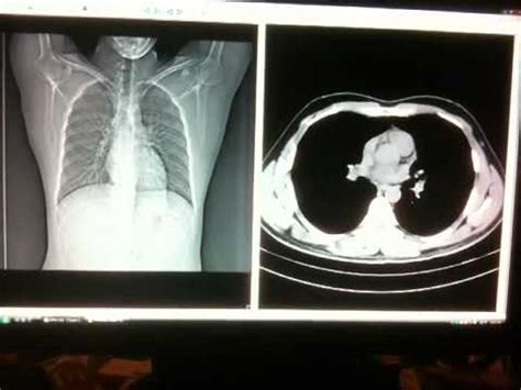 What Does Lung Scarring Look Like On Ct Scan Ct Scan Machine