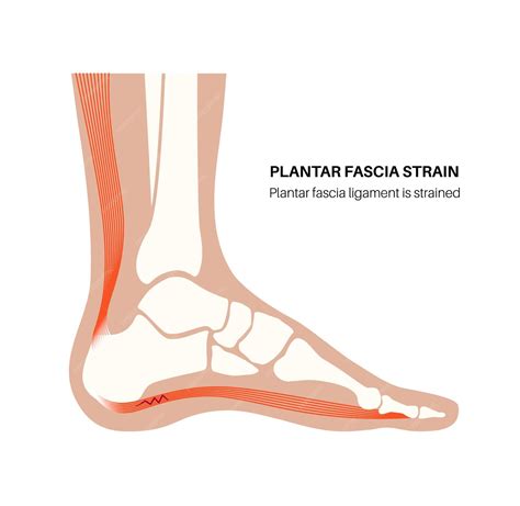 Premium Vector | Plantar fascia strain anatomical poster Tear of the