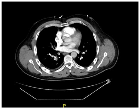 Computed Tomography Angiography Of The Chest Bilateral Pulmonary