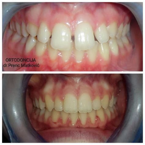 Ortodoncija za odrasle i djecu invisalign prozirni aparatić ORTHO