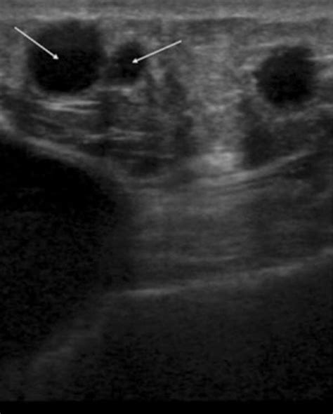 Fat Necrosis Breast Ultrasound