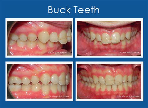 How to Get Rid of Buck Teeth Without Braces?