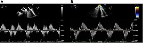 A Pulsed Wave Doppler Signal Sampling The Left Upper Pulmonary Vein