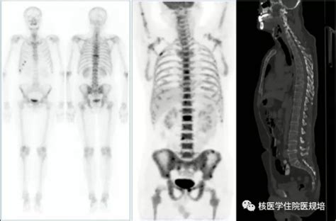 中华医学会核医学分会 病例报告 189多发性骨髓瘤的骨显像与FDG PET CT显像