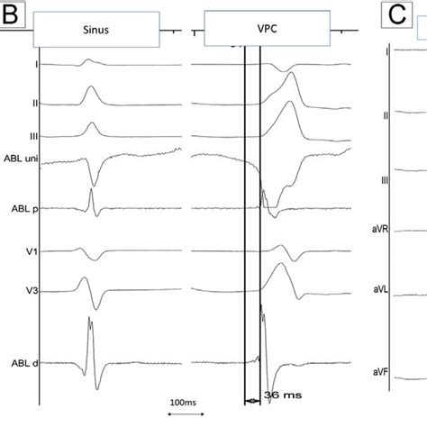 A The 12 Lead Electrocardiogram Showing Ventricular Premature