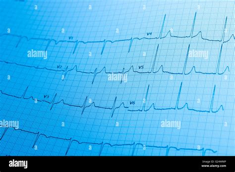 Electrocardiogram Ecg Printed On Graph Paper Stock Photo Alamy