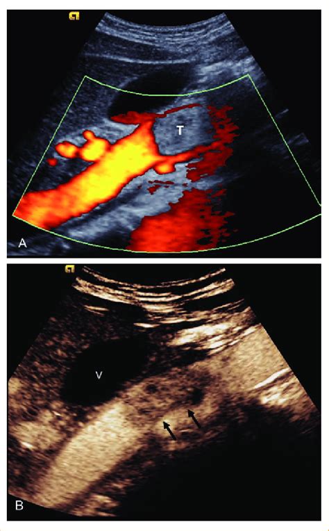 Corte Longitudinal De La Vena Cava Inferior A La Exploración Doppler