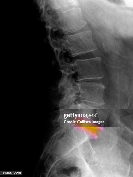 Degenerative Disc Disease Photos And Premium High Res Pictures Getty