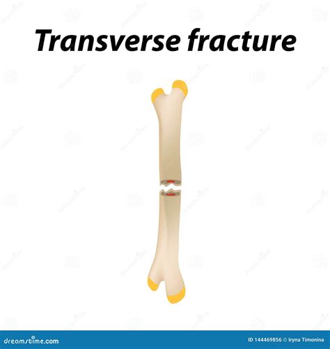 Transverse Bone Fracture. Infographics. Vector Illustration on a Lined ...