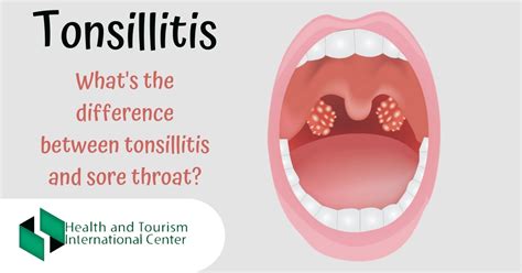 How To Distinguish Sore Throat From Tonsilitis Hti Centers Medical