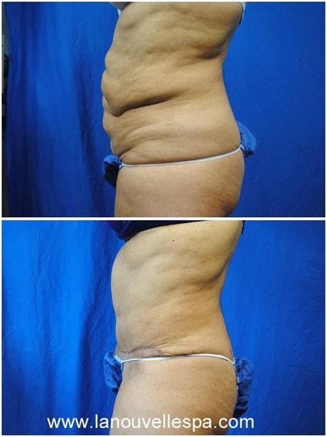 Abdominal Plasty Before And After Photos By Dr Hanna Oxnard Ventura