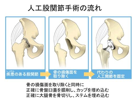 人工股関節置換術 （tha Total Hip Arthroplasty）｜みえロコモリウマチクリニック