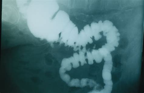 Blood In Stool Diverticulitis - Stools Item