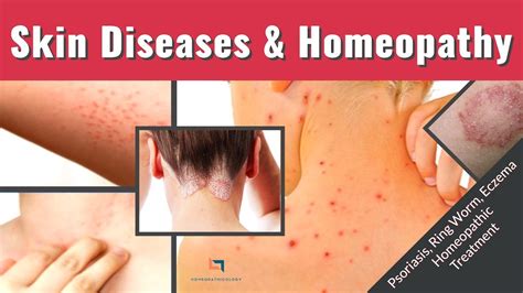 Skin Diseases And Homeopathy [types And Treatment] Homeopathic Medicine