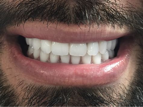 Smile Gallery Before And After Dentures In Surrey Bc