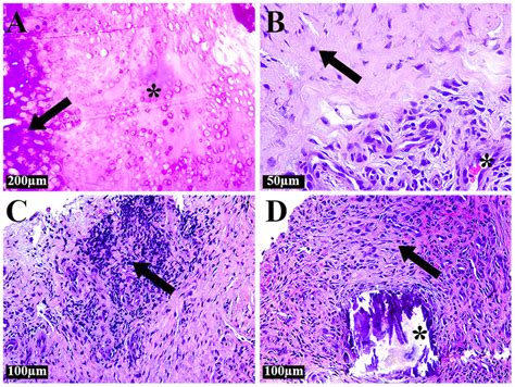 Histological Examination Of Excised Tissues A Large Area Of