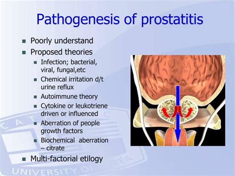 Ppt Prostatitis And Sexual Dysfunction Powerpoint Presentation Id