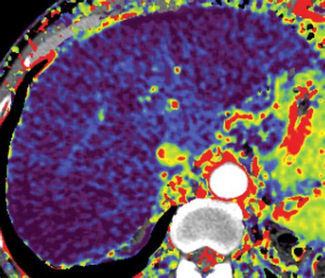 Quantitative Color Mapping Of The Arterial Enhancement Fraction In