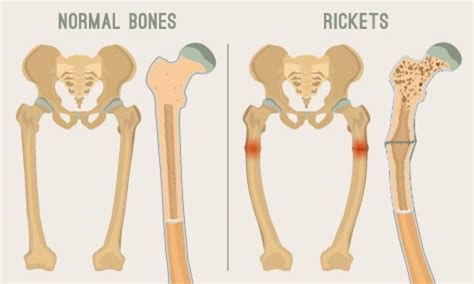 Rickets: Symptoms, Risk Factors and Treatment | Longevity