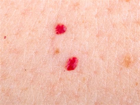 What Are Red Moles, And Are They Dangerous? - First for Women