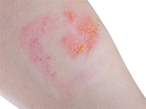 How To Get Rid Of Itchy Inner Thigh Skin Rashes At Timothy Nava Blog