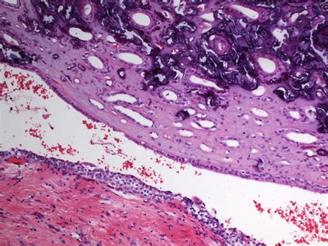 Medullary Nephrocalcinosis Histology Image