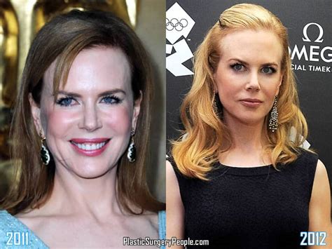 Did Nicole Kidman Have Facelift & Lip Augmentation?