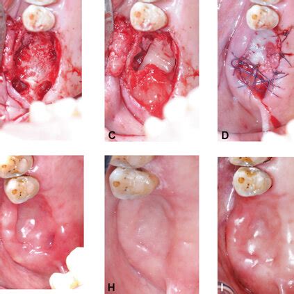 Preoperative Periapical Radiographic Examination Showed Retained