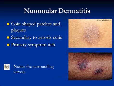 Ppt Dermatitis 101 Diagnosis And Treatment Of Eczema Powerpoint Presentation Id4483862