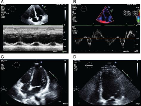 Echocardiographic Evaluation Of The Right Ventricle Clinical