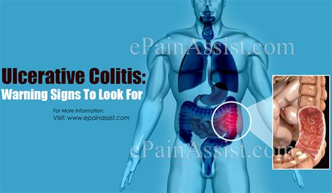 Ulcerative Colitis Warning Signs To Look For