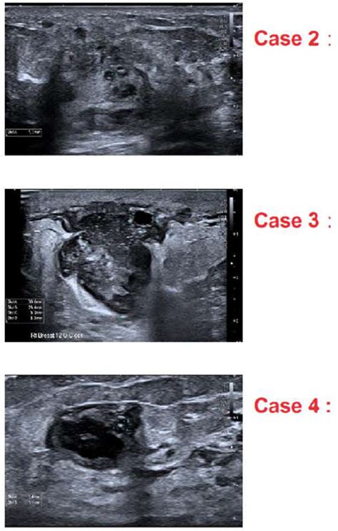 HIGH RESOLUTION ULTRASOUND FEATURES UNIQUE TO CYSTIC NEUTROPHILIC