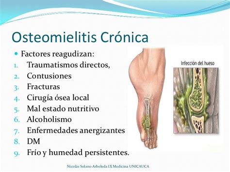 Osteomielitis Crónica