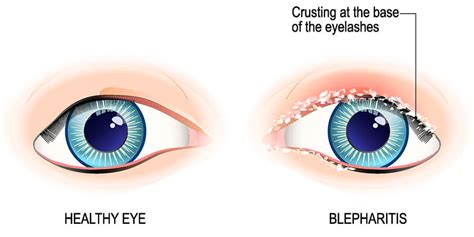 Blepharitis A Common Condition Eye Health Clinic