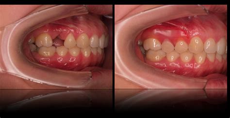 Metal-free partials and dentures - Cynthia E. Paquette DDS