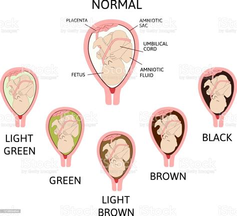 羊膜嚢中の羊水の色正常および危険の変種 羊水のベクターアート素材や画像を多数ご用意 羊水 緑色 ヒトの胎児 Istock