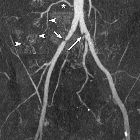 16 MDCT Angiography Of Aortoiliac And Lower Extremity Arteries