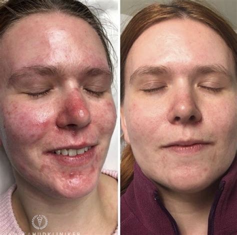 IPL Rosacea Svenska Hudkliniker