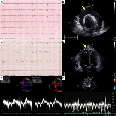 Frontiers Case Report Successful Treatment Of Malignant Pericardial