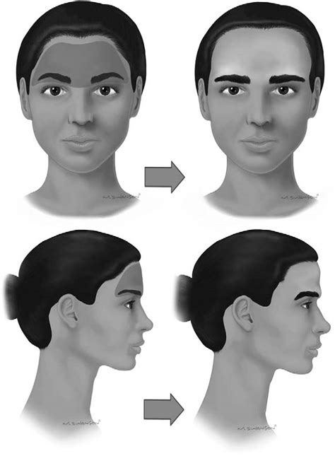 Masculinization Of The Upper Face Depicting Forehead And Supraorbital