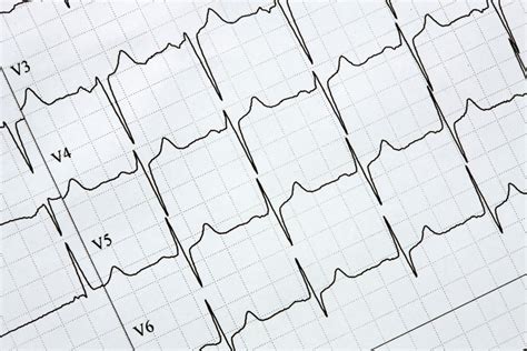 Actualizaci N Online En Electrocardiograf A