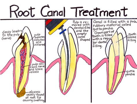 Is Root Canal Treatment Painful?