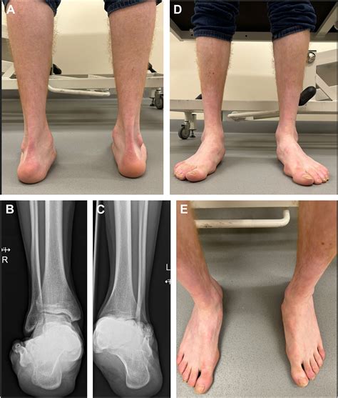 The Paradoxical Pes Planus Varus In Müller Weiss Disease Foot And