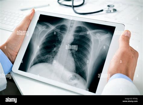 Radiografia Toracica Immagini E Fotografie Stock Ad Alta Risoluzione