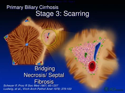 Ppt Cholestatic Liver Disease Pbc And Psc Powerpoint Presentation Free Download Id 5127077