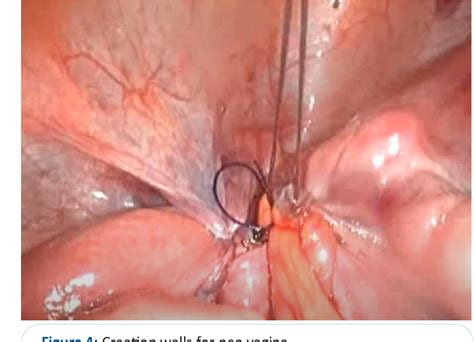 Figure From Successful Treatment Of Rare Disorder Mayer Rokitansky