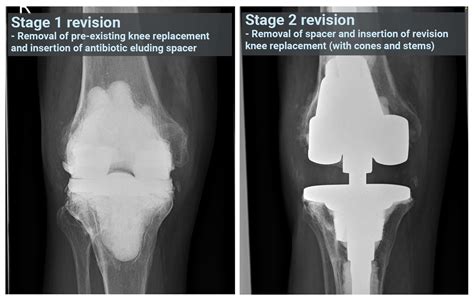 Hinged Knee Replacement After Revision